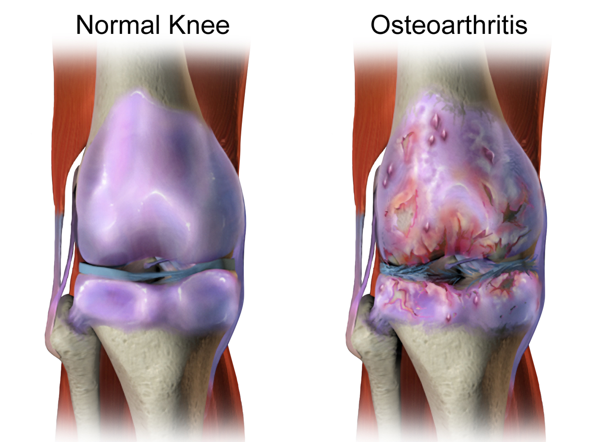 Home - Mostfit Physiotherapy Center The Difference Between Osteoarthritis and Rheumatoid Arthritis