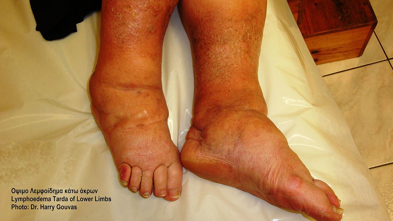 The Best Lymphoedema Therapy Specialists in Nairobi